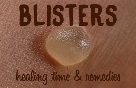 Do blisters heal faster if you pop them?