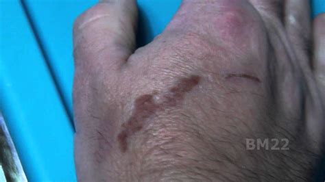 Do blisters leave scars?