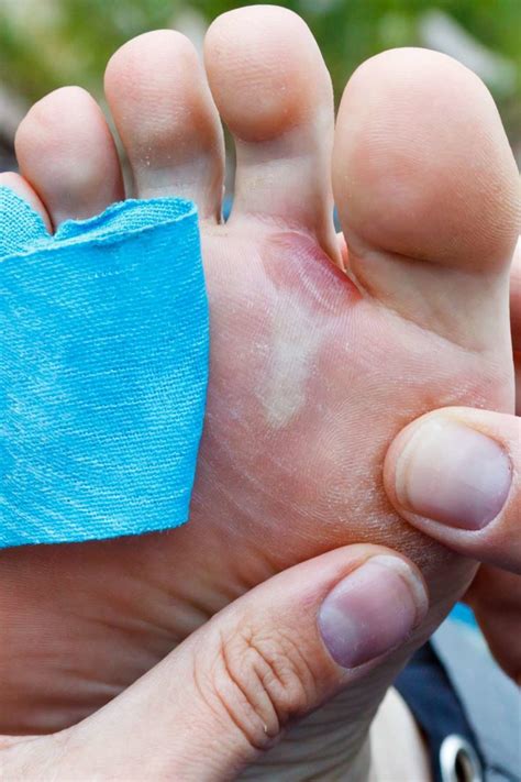 Do blisters pop on their own?