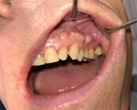 Do bone spurs in gums go away?