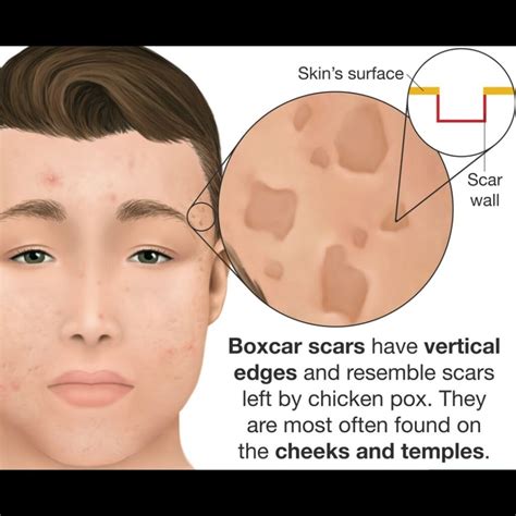 Do box acne scars go away?