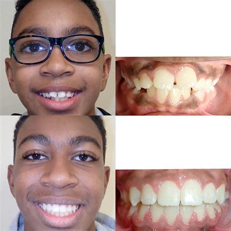 Do braces change the way you look?