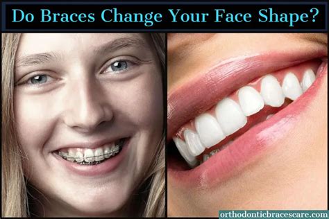 Do braces change your face shape?