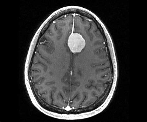 Do brain tumors always show on MRI?