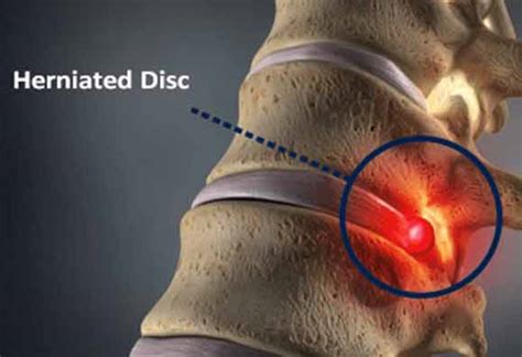 Do bulging discs ever fully heal?