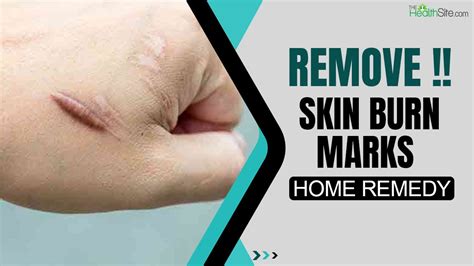 Do burn marks on skin go away?