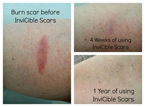 Do burn scars heal white?