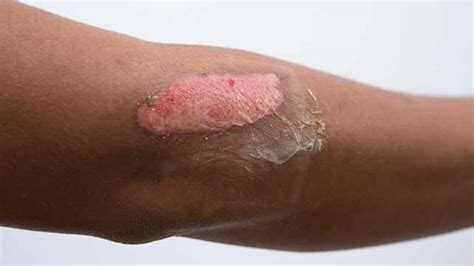 Do burns get darker as they heal?