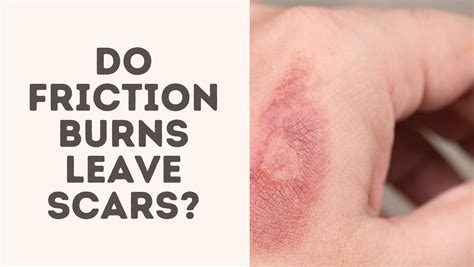 Do burns leave scars?