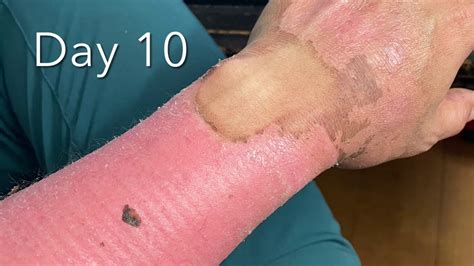 Do burns turn black when healing?