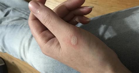 Do burns turn white while healing?