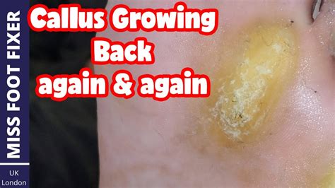 Do calluses grow back?