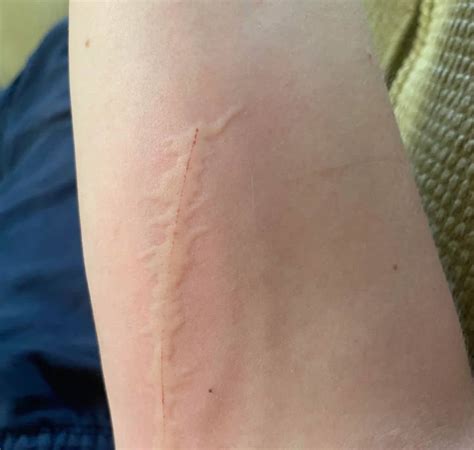 Do cat scratches leave scars?