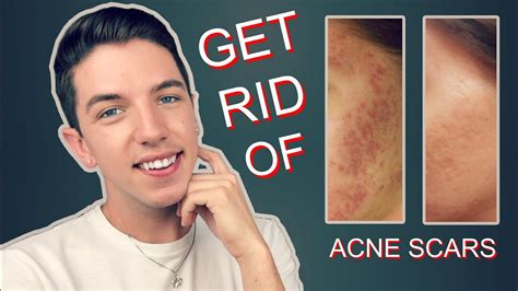 Do chest acne scars go away?