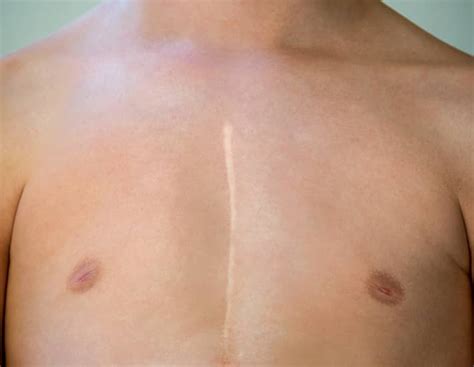 Do chest scars fade?