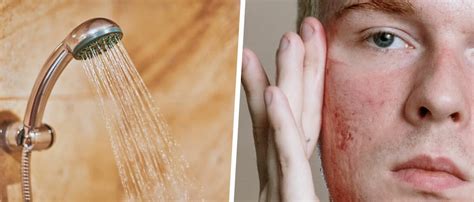 Do cold showers help acne?