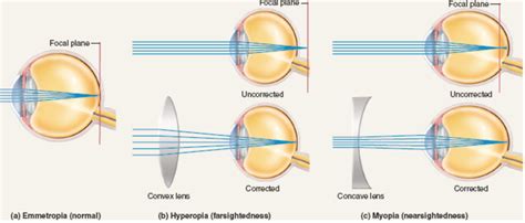 Do contacts help correct vision?
