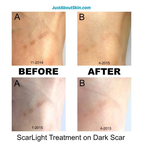 Do dark scars get lighter?