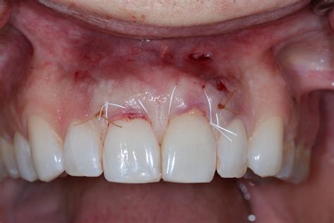 Do detached gums reattach?