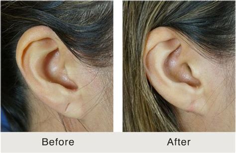 Do earlobes tear easily?