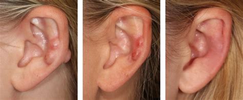 Do earring holes leave scars?