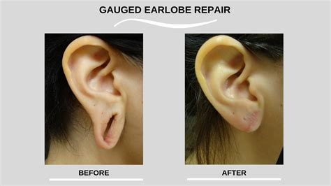 Do ears shrink back from gauges?
