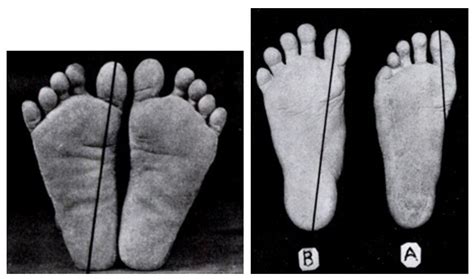 Do feet change shape with age?