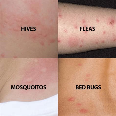 Do fleas bite every night?