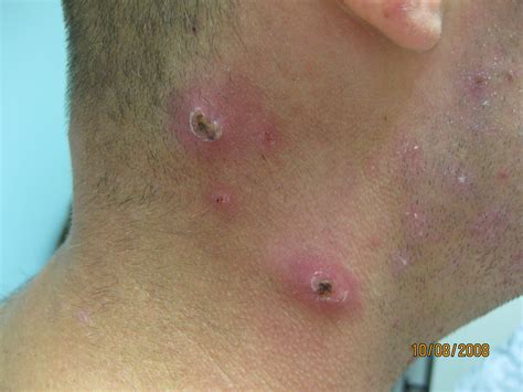 Do folliculitis pimples burst?