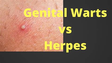 Do genital warts always spread?