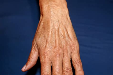 Do girls have veins on their hands?