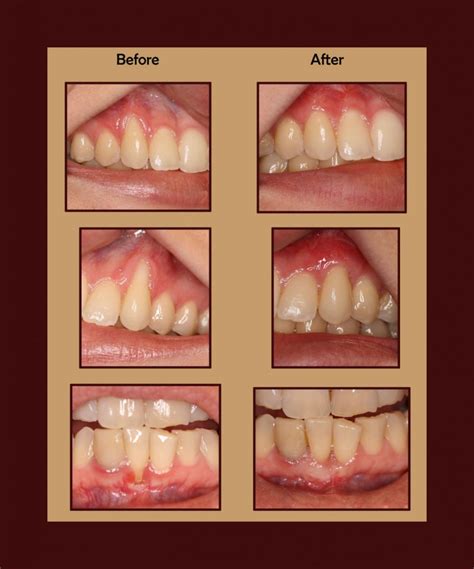 Do gum grafts stop periodontitis?