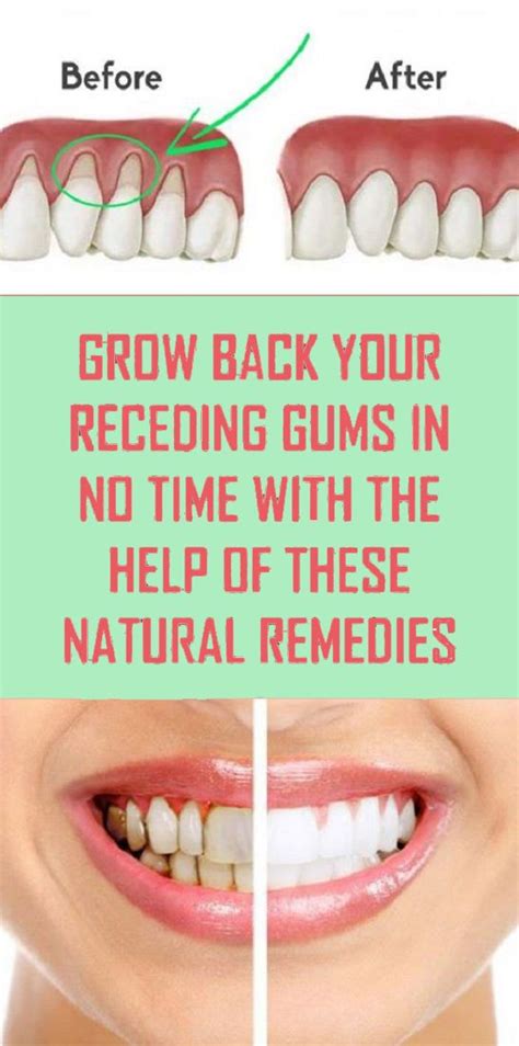 Do gums heal on their own?