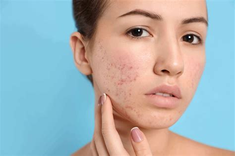 Do guys care if a girl has acne?