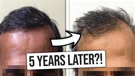 Do hair transplants last forever?