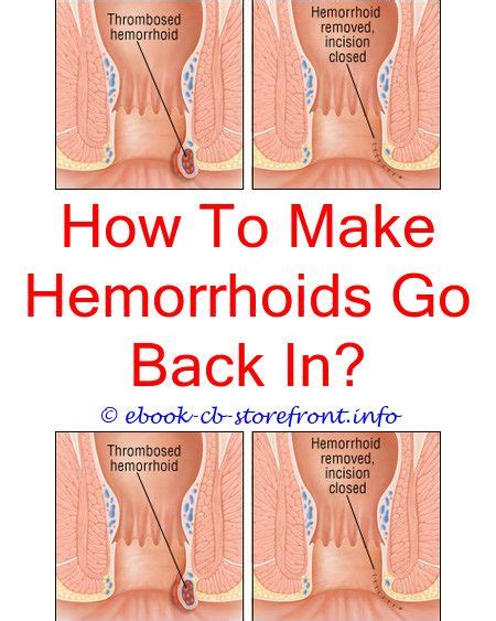 Do hemorrhoids feel like a blockage?
