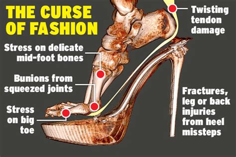 Do high heels damage knees?