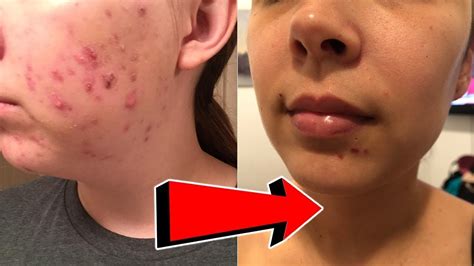 Do holes from acne heal?