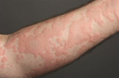 Do hot showers affect hives?