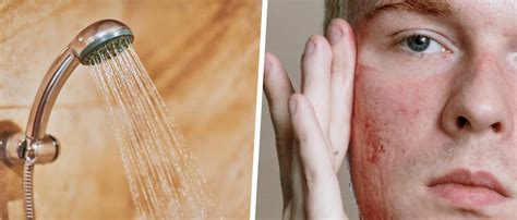 Do hot showers cause back acne?