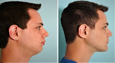 Do jaw exercises work?