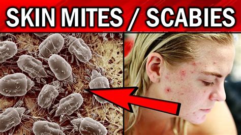 Do mites go away naturally?