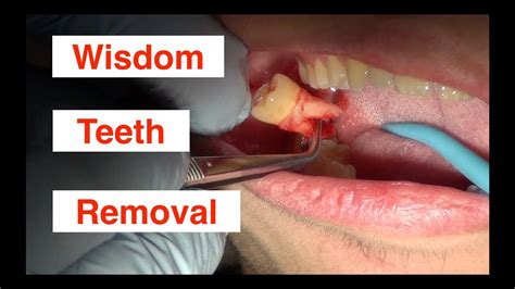 Do models get wisdom teeth removed?