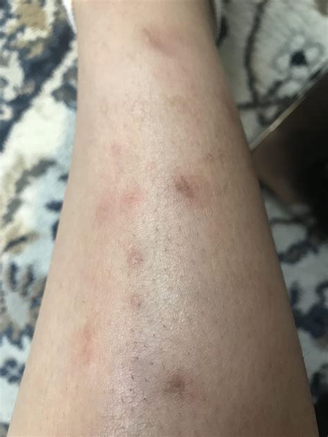 Do mosquito bites scar?