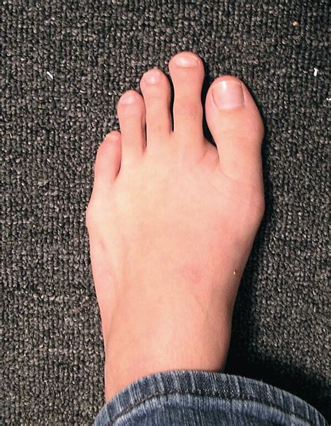 Do most people have Morton's toe?