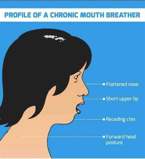 Do mouth breathers look different?