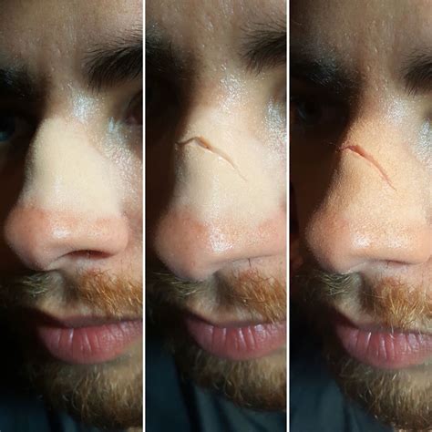 Do nose scars go away?