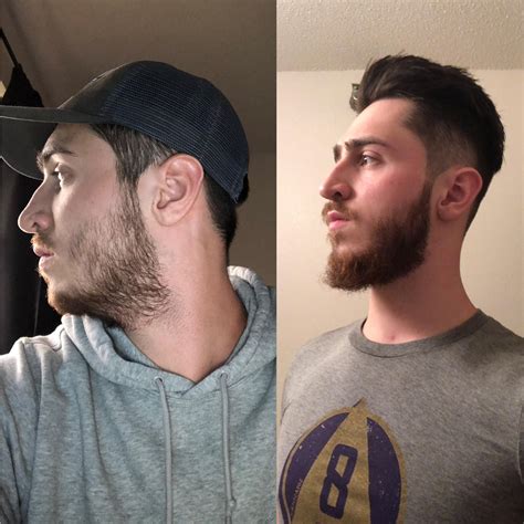 Do patchy beards grow?
