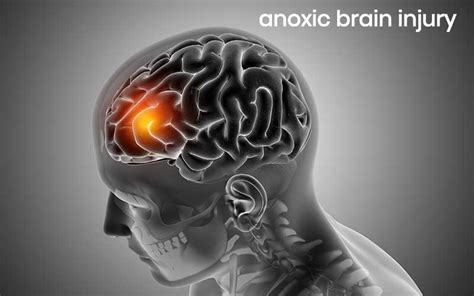 Do people wake up from anoxic brain injury?