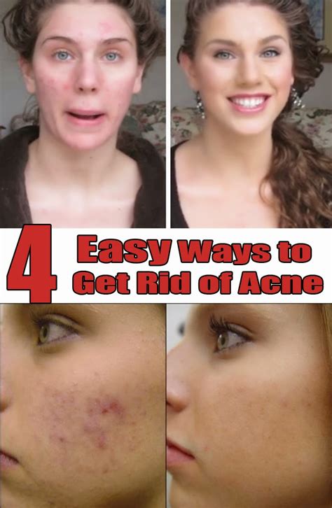 Do people with acne age slower?